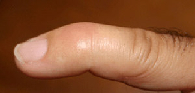 El ungüento del hongo sobre las uñas de los pies a los niños